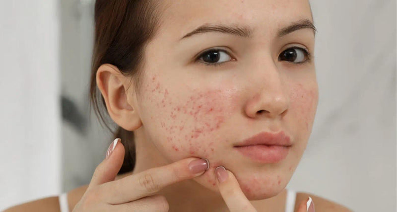 Cẩm nang mờ thâm mụn chuyên sâu: Giải mã sức mạnh phục hồi làn da từ Nghệ Vàng truyền thống